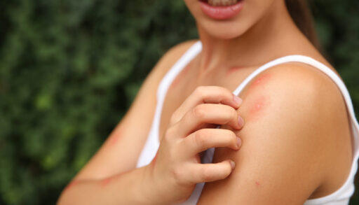 Woman scratching a bug bite on her arm.