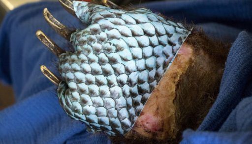 burns treated with fish skins