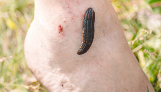 A leech stuck to a man's ankle